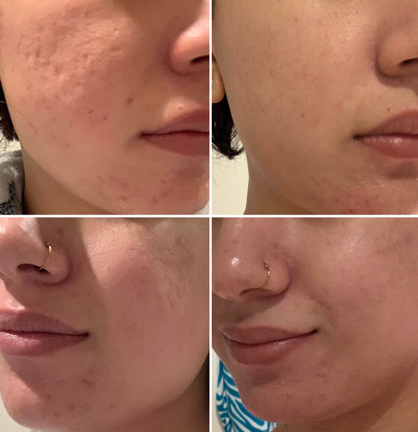 Acne Scar Results ( 5 days apart)