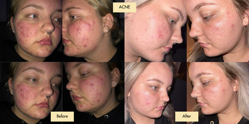 Bangn Body Firming Lotion to Combat Acne Fast