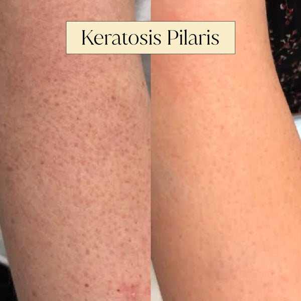 Smooth Skin Secrets: Our Guide on Treating Keratosis Pilaris