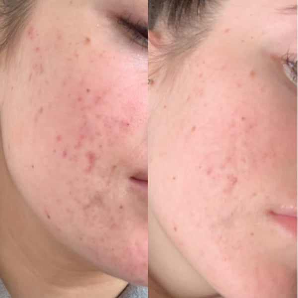 Hormonal Acne Treatment Results