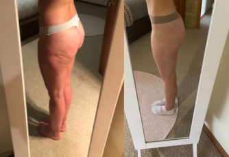 How to Reduce Cellulite and Achieve Smooth and Healthy Skin