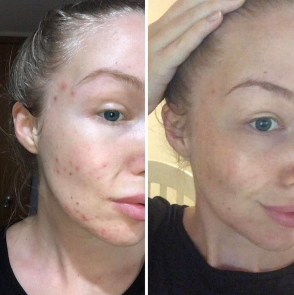 5 day acne results