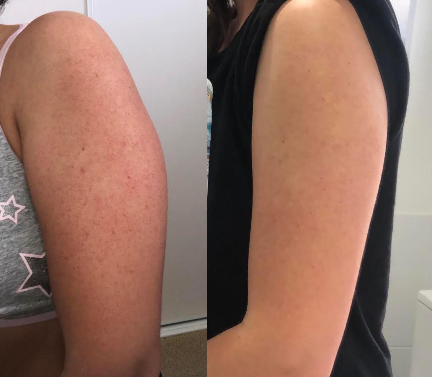 Keratosis Pilaris treated in 2 days