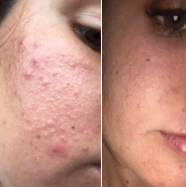 Hormonal Acne 7 Days results