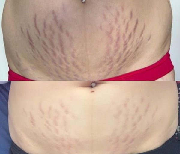 Stretch Mark results in 3 weeks