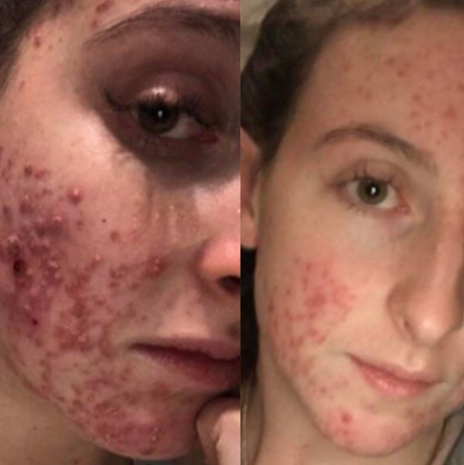 Hormonal Acne 3 Week Results