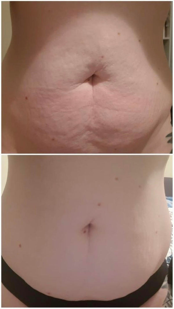 Firming, Stretch Marks & Cellulite Results