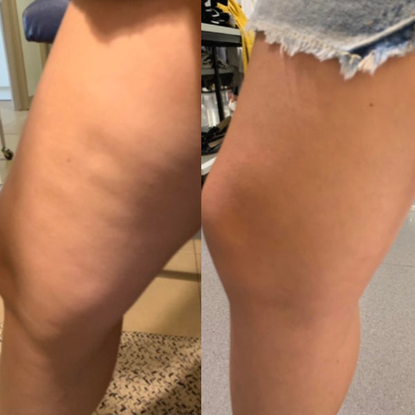 4 Week Cellulite Treatment Results