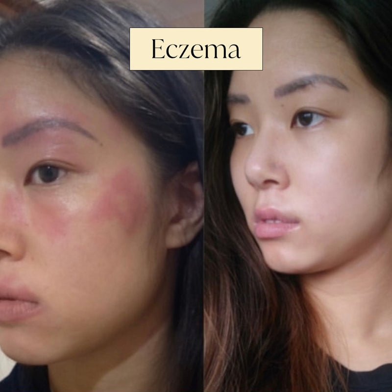 Firming Lotion | Face & Body Firming Cream | Bangn Body Eczema Before and after