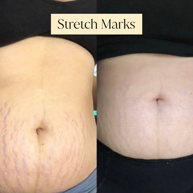Firming Lotion | Face & Body Firming Cream | Bangn Body Stretch Marks before and after 